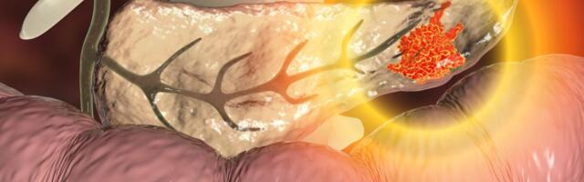 Ameerika teadlaste kinnitusel võivad sapikivid hoiatada pankreasevähi eest