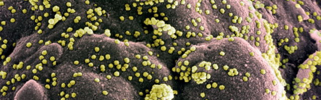 Värske aruanne: ebatavaline koroonaviirus on võimeline kahjustama väga paljusid inimelundeid