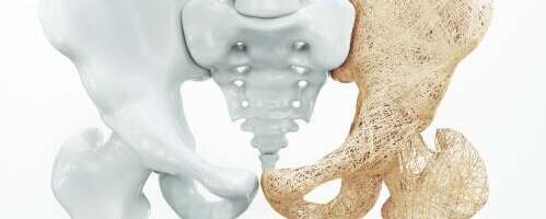 Kas sul on mõni luuhõrenemise riskifaktor?