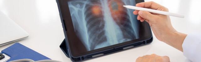 Soome surmavaima vähi esinemissagedus naistel on kahekordistunud