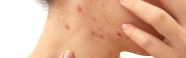 Põletikulise akne korral saad kiiret ja tõhusat leevendust oma köögikapist
