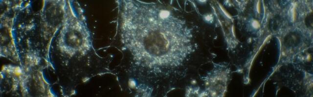 Neljanda staadiumi vähile on tekkinud paremad ravivõimalused