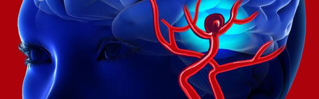 Aneurüsmi tõttu sureb üha vähem soomlasi