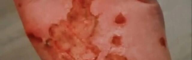 Apsakas koduses pediküüris põhjustas naisele kolmanda astme põletusi