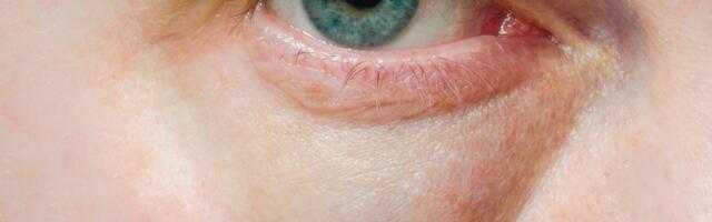„Mõned juhtumid on tõsisemad kui teised.“ Dermatoloogide sõnul võib silmade sagedasel paistetusel olla 10 võimalikku põhjust