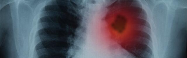 Uuringu andmeil kaitseb tõhus immuunsüsteem kopsuvähi eest