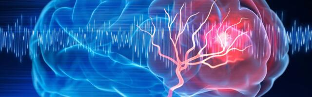 Aruanne: Insult võib 2050. aastaks põhjustada ligi kümme miljonit surmajuhtumit aastas