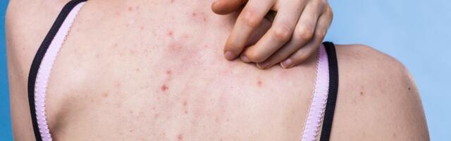 Zašto su akne na leđima toliko tvrdoglave? Ovih 7 promena u rutini daju rezultate već za par nedelja