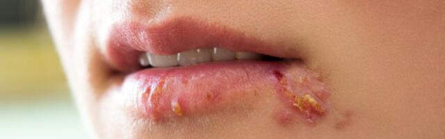 Uuring: huuleherpese praegune vorm kujunes välja juba tuhandeid aastaid tagasi