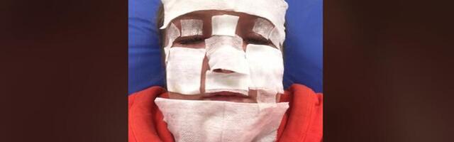 18 minutit katkises solaariumis viis naise põletustega haiglasse