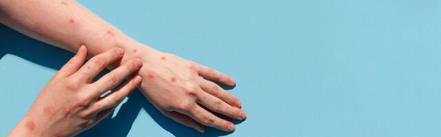 Euroopa Liit kahekordistas ahvirõugete vaktsiini tellimust