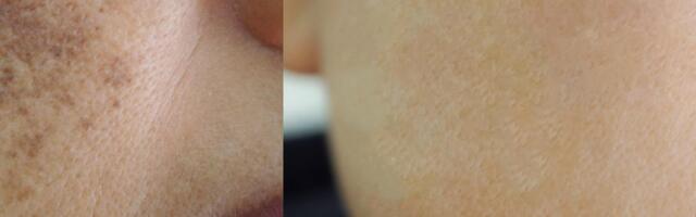 Kas prooviksid? See vähetuntud vahend võib aidata pigmendilaike eemaldada