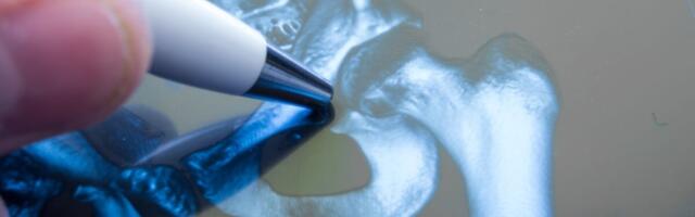 Mis muutub patsiendi jaoks endoproteesimise raviteekonnal?