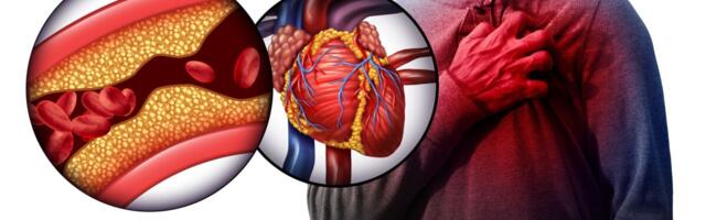 Täiskasvanu koronaartõbe mõjutavad juba  lapsepõlves esinenud riskitegurid