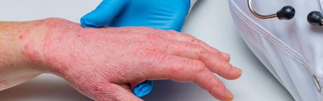 Psoriaasi ravi EuroGuiDermi juhendi põhjal: kohandused Eesti oludele