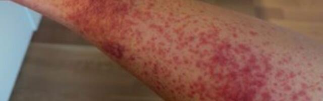 KURIOOSUM: veebipoest tellitud toode viis soomlanna erakorralise meditsiini osakonda