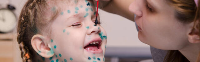 Teeme selgeks: milliste sümptomitega algavad tuulerõuged ja kas briljantrohelist tasub kasutada?