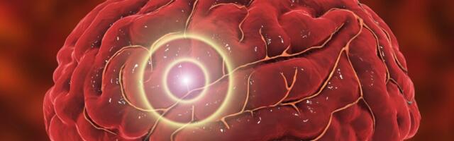 Ka kerge ajutrauma järel suureneb risk haigestuda isheemilisse insulti