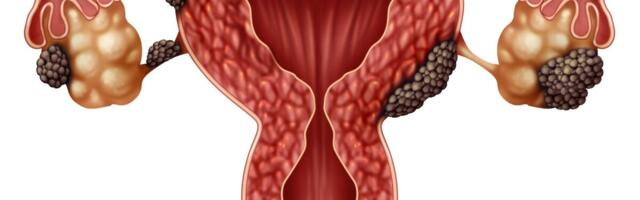 Uuring: endometrioos on varajase menopausi potentsiaalne riskitegur