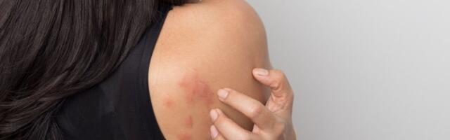 Krooniline urtikaaria on alaravitud piinav haigus