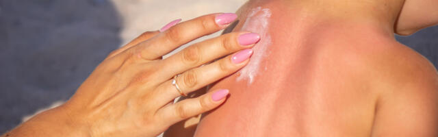 KUUM ILM! Mida teha peale päikesepõletust?