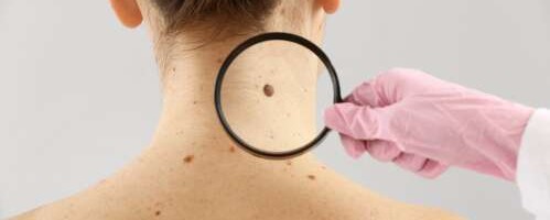 Milline haigus on melanoom?