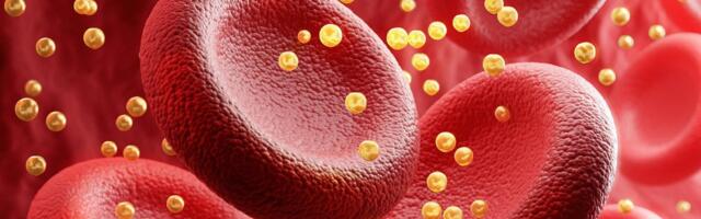 Võitlus „vaikse tapjaga.“ Kardioloog hoiatab_ kõrge kolesterooli esimene avaldumise märk võib olla kohe fataalne