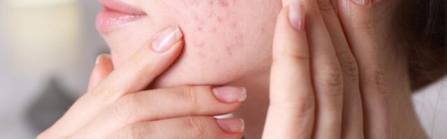 Täiskasvanute akne ja post-pill-akne: mida teha ja millal pöörduda arsti poole?