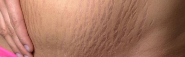 Su nahal on palju «tiigritriipe»? Loe, mida nende osas ette võtta