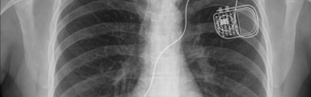 Kardiostimulatsioon – kas kaug-kodujälgimine kõigile?