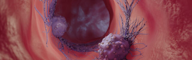 VAERS andmebaas näitab Covid-19 vaktsiini kõrvalnähtudena vähijuhtumite 100-kordset kasvu