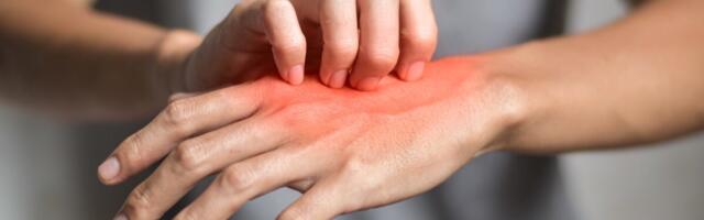 Soomes on sügelistesse nakatumine viiekordistunud