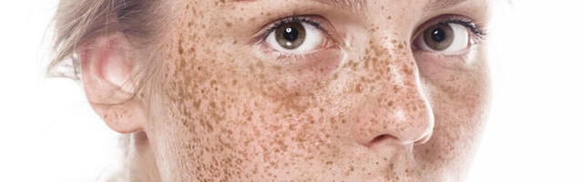 Päikese pahem pool – pigmendilaigud