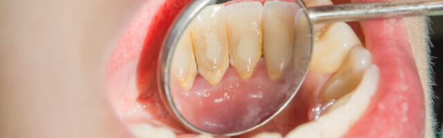 Jääkülmad joogid võivad kahjustada hammaste tervist