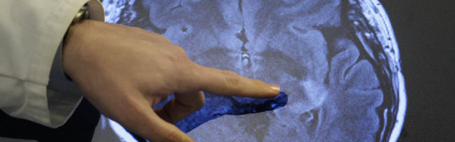 VIIRUSE AVARDUV PALE | Kas koroonaviirus võib tõesti põhjustada noortel ajuinfarkti?