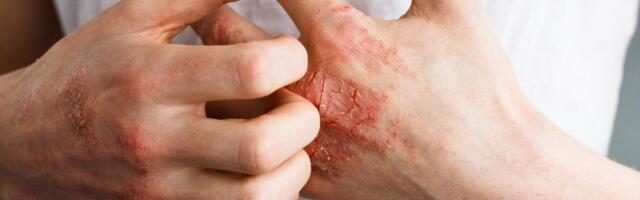 5 fakti, mida peaksid teadma ekseemist