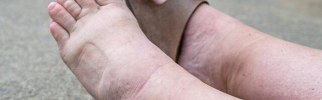 Jalad turses? Tõestatud viisid, kuidas jäsemete turset kontrolli all hoida