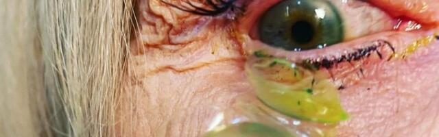 HÄIRIV VIDEO ⟩ Naine sai valusal viisil teada, miks ei tohi kontaktläätsedega magada