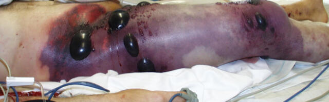 Ukraina sõdurite seas levib jube haigus