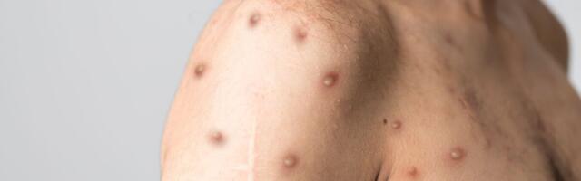 Eestis lisandus kaks ahvirõugetesse nakatumist