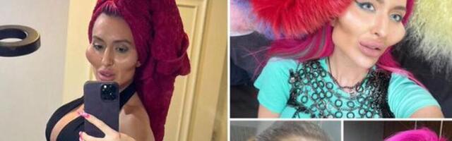 Maailma suurimate põskedega naisel pole täitesüstidest veel küllalt