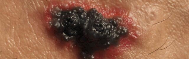 Uuring: Personaliseeritud melanoomi vaktsiin võib ära hoida vähi taastekke