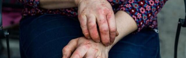 Uuring: IL-13 retseptori ekspressioon kaitseb eksperimentaalse nahavähi eest