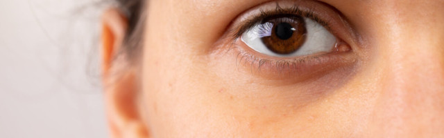 Silmaalused turses ja tumedad? Üks lihtne nipp aitab silmaaluseid kiiresti turgutada