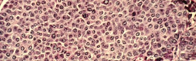 Läti teadlaste kordaminek_ nende loodud tehisintellekti mudel tuvastab vähirakke 92% täpsusega