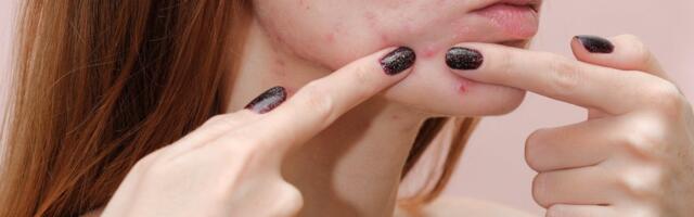 Nägu on kahtlaselt punniliseks läinud? Sellisel juhul väldi järgnevaid maitsvaid toite