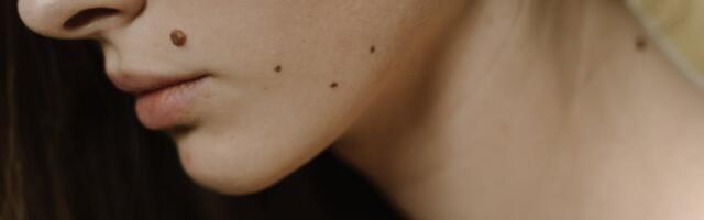 Mobiilne nahakasvajate diagnoosikabinet tuleb Tõrva!