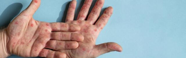 Roche'i tegevjuhi sõnul on Euroopas MPOXi haigestunuid räägitust rohkem