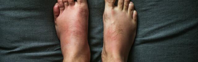 Pärilik angioödeem – eri kohtades tursetega kulgev raske haigus