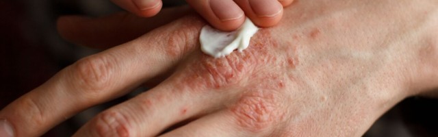 Psoriaasi lokaalse ravi põhimõtted